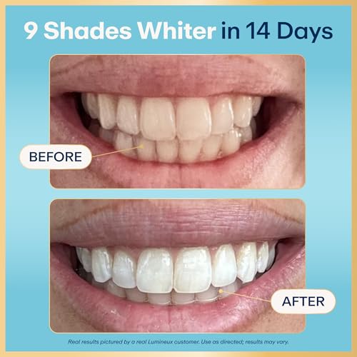Before-and-after photos of a real Lumineux customer's smile showing up to nine shades whiter in 14 days. Results may vary.