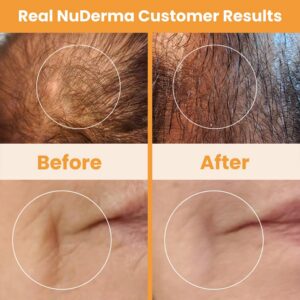 NuDerma High-Frequency Skin Therapy Wand: A Neutral Review of the At-Home Beauty Device