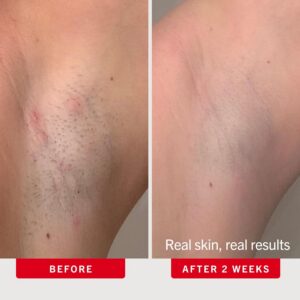 First Aid Beauty Ingrown Hair Pads: A Neutral Review of the Aftershave Treatment Pads