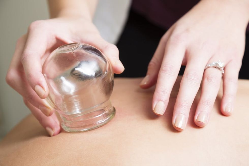 Accupuncturist uses cupping on a client.