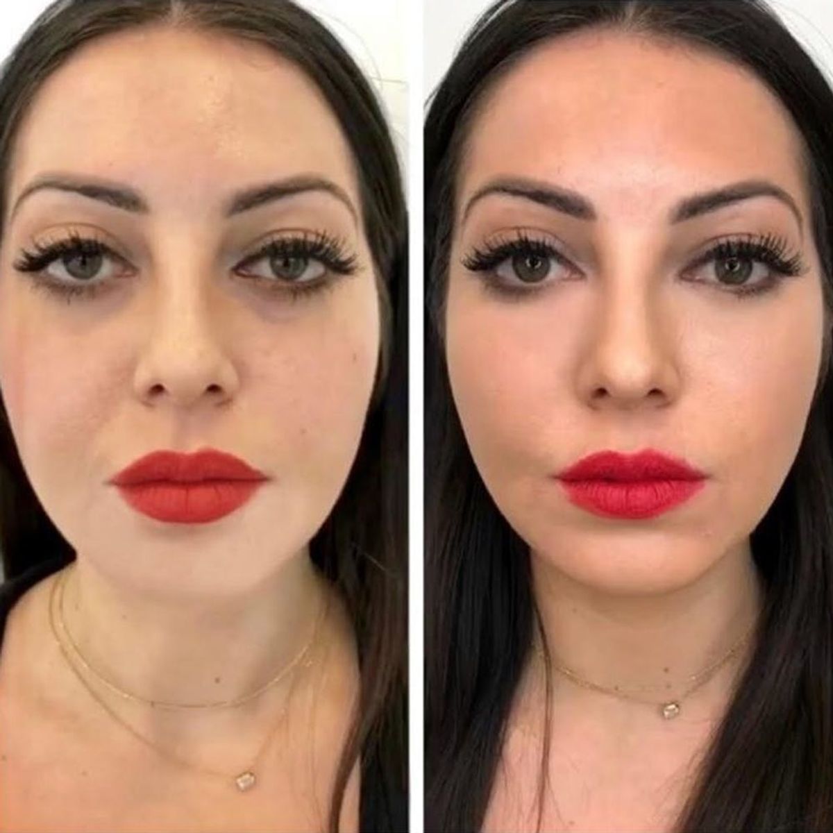 Could This Treatment Mean the End of Dark Circles… for Good?