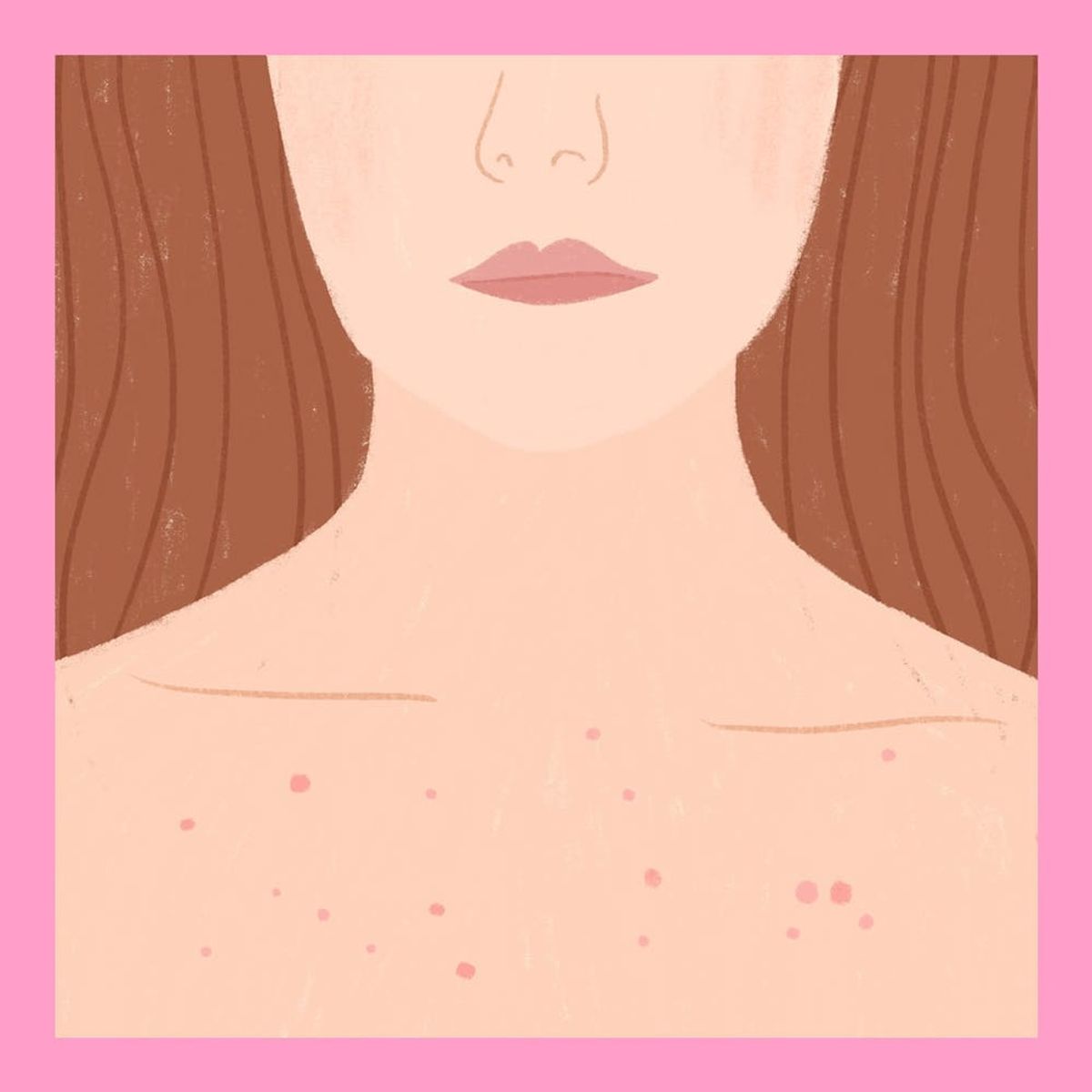 This Is How to Heal Chest Acne, According to Dermatologists