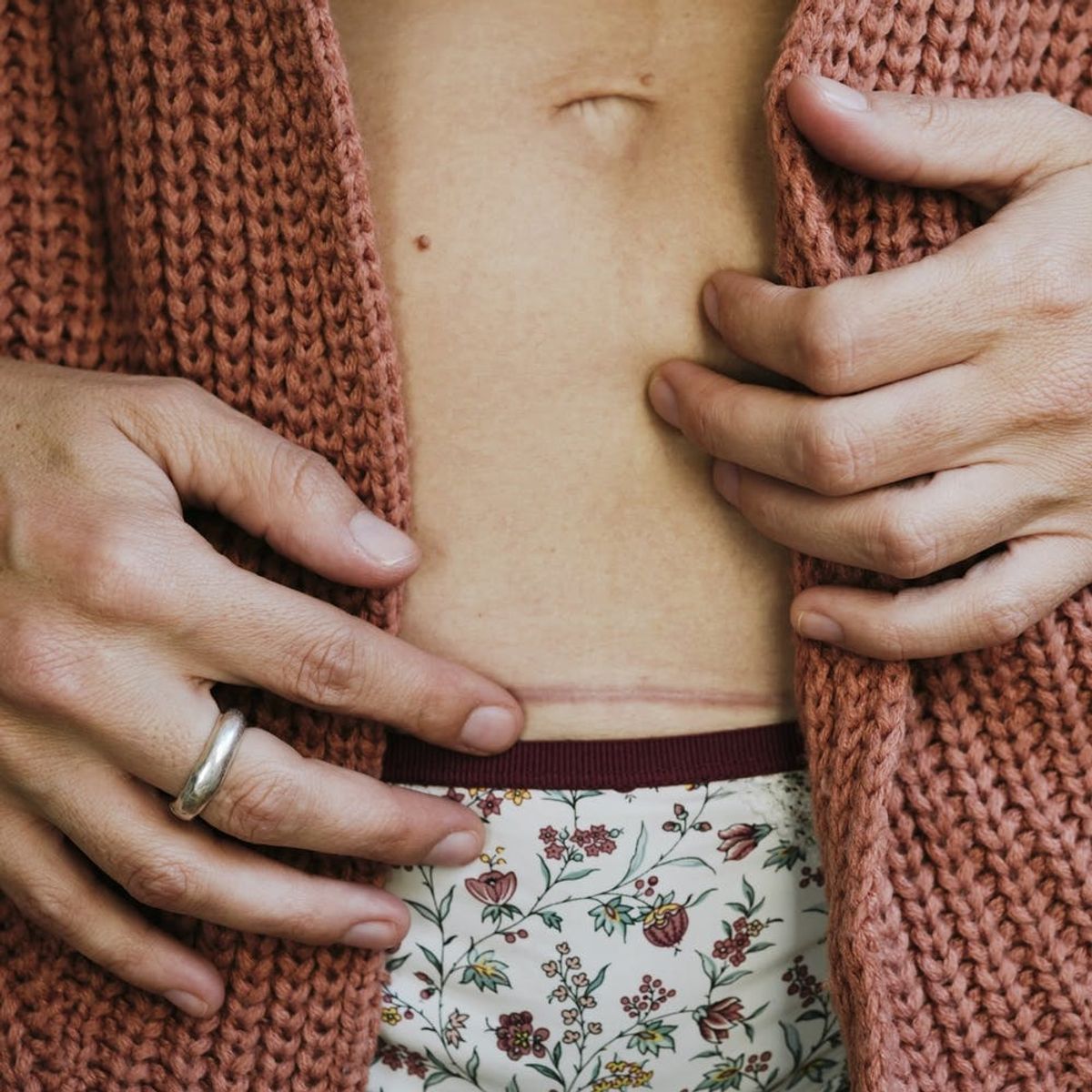 This Is Why We Get Scars — and How to Feel Positive About Yours