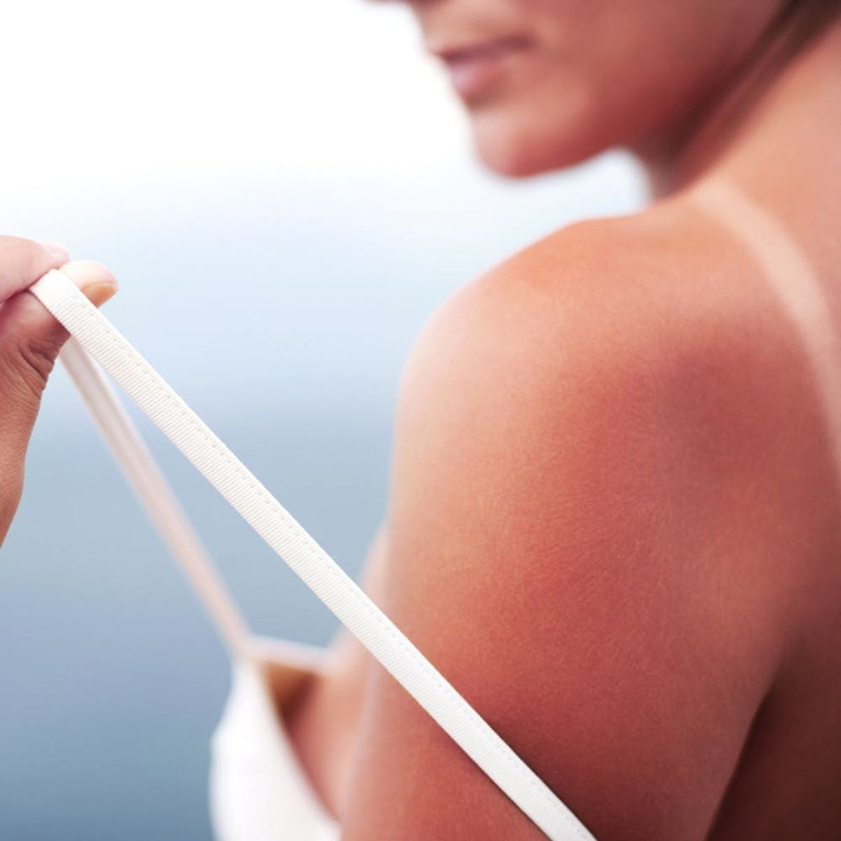 How to Really Prevent, Soothe, and Treat Sun Burns