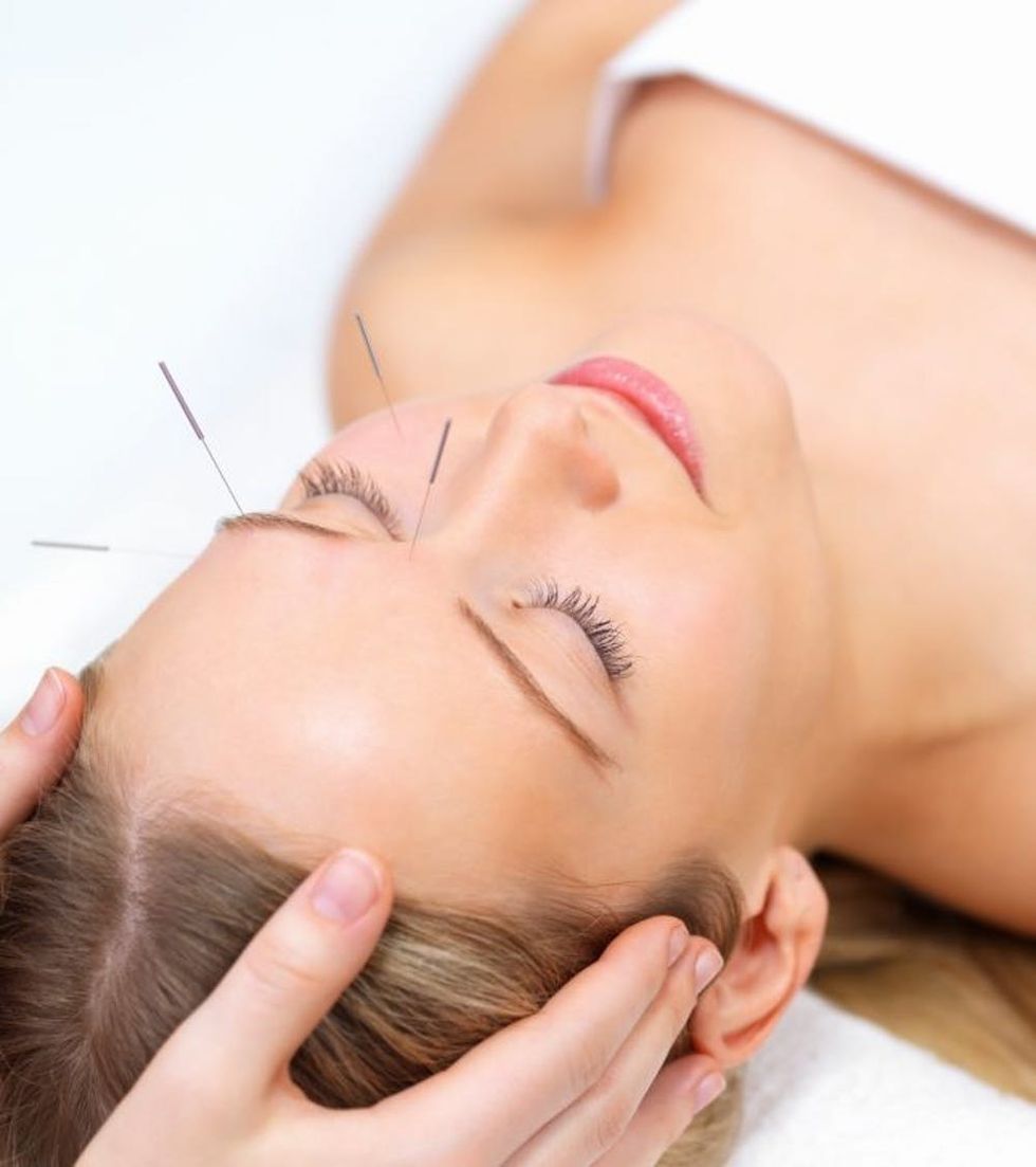 woman in acupuncture therapy