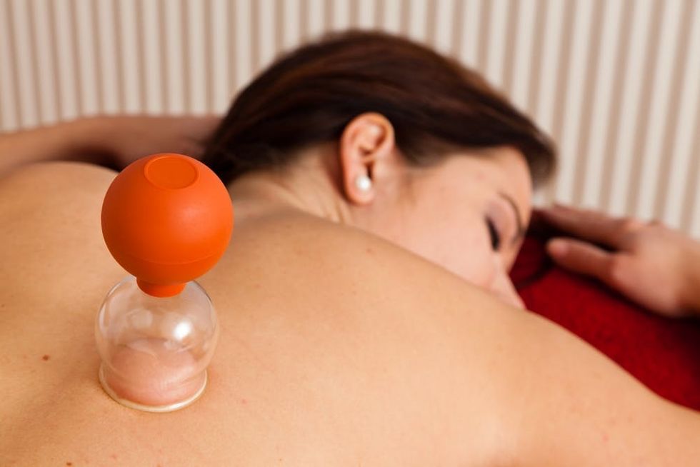 Woman laying down receiving a cupping treatment. 