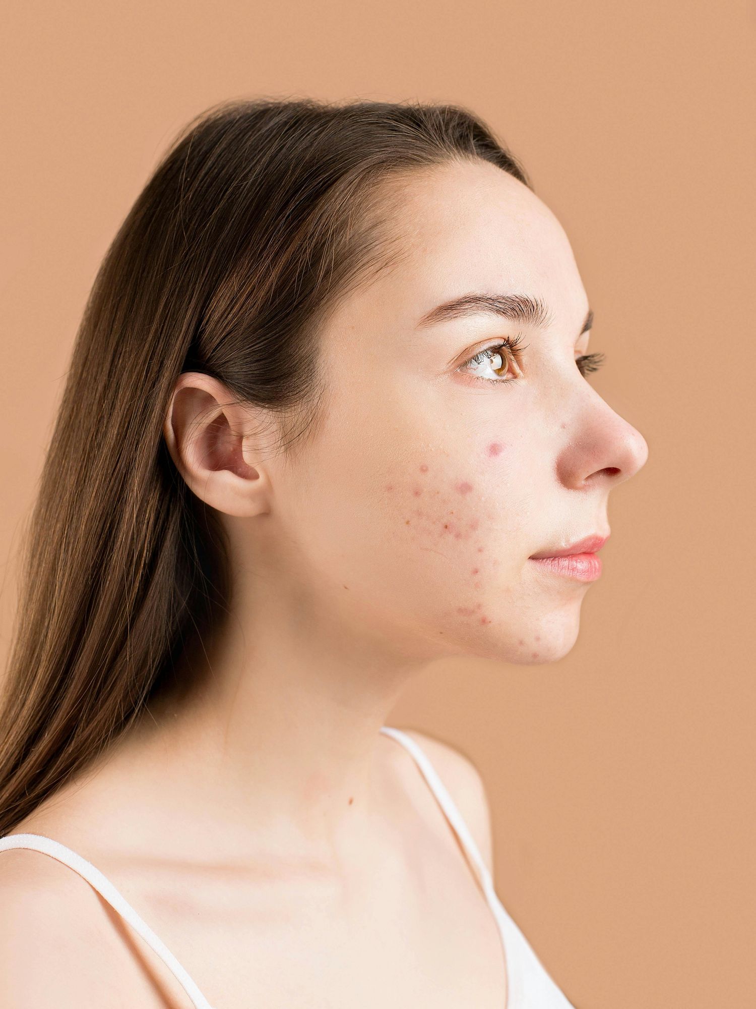 woman with face acne